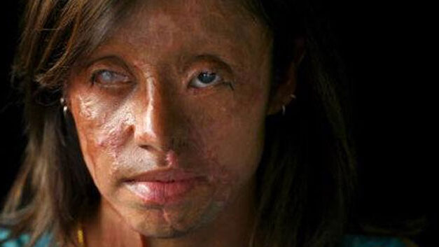 Colombia demands govt action following pair of acid attacks against women